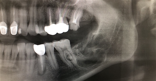 关于拔牙的朋友圈文案